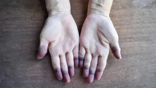 Types of Cyanosis: Central vs. Peripheral